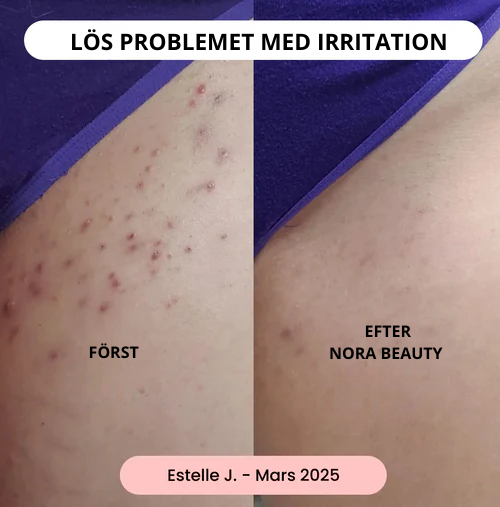 Nora Beauty™ - Intim rakning utan irritation