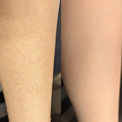 Nora Beauty™ - Intim rakning utan irritation