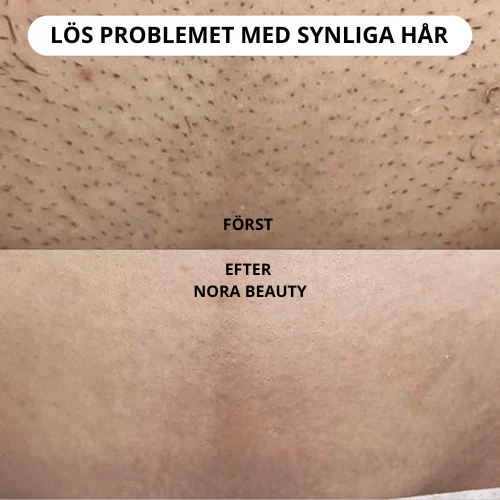 Nora Beauty™ - Intim rakning utan irritation